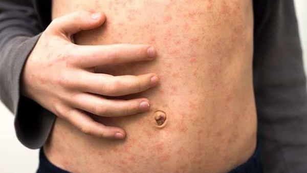 انتشار وباء الحصبة في إسرائيل بسرعة ملحوظة